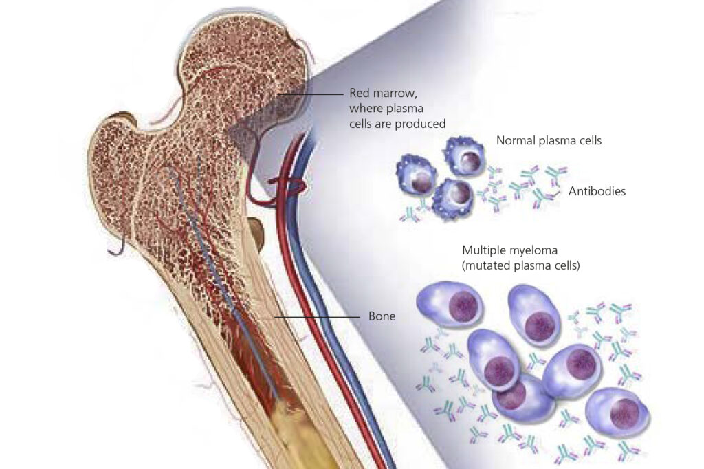 Image of how Multiple Myeloma affects the bone marrow